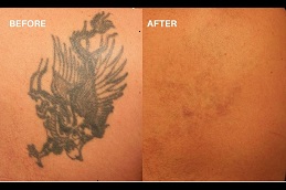 Best laser-tattoo-removal-for-new-tattoo in Abu Dhabi