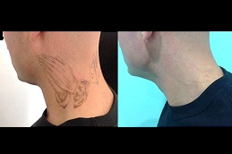 Best laser-tattoo-removal-for-new-tattoo s Clinic in Dubai
