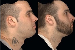 laser-tattoo-removal-for-new-tattoo Clinic in Dubai