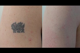 http://www.royalclinicdubai.com/wp-content/uploads/2022/05/Best-how-long-after-laser-tattoo-removal-can-i-get-a-cover-up-in-Abu-Dhabi.jpg