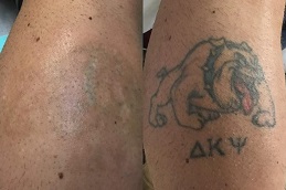 best how-long-after-laser-tattoo-removal-can-i-get-a-cover-up in dubai