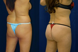Best Clinic of French Butt Reshaping Dubai