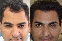 Best hair-transplant-charges Clinic in Dubai
