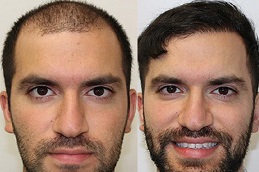 hair-transplant-charges Clinic in Dubai