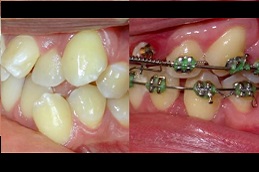 Best Clinic of Dental Braces Dubai