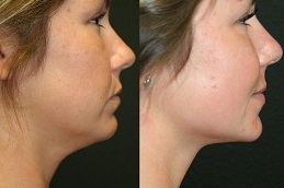 Best laser-fat-removal-for-face Clinic in Dubai