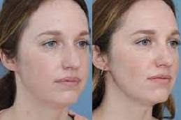Best laser-fat-removal-for-face in Abu Dhabi