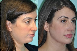  laser-fat-removal-for-face-Clinic-in-Dubai