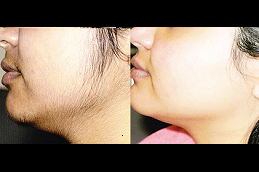 Best laser-hair-removal-for-womens-facial-hair in Abu Dhabi