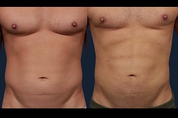 best six-pack-abs-surgery-cost in dubai