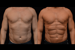 best six-pack-abs-surgery-cost in dubai