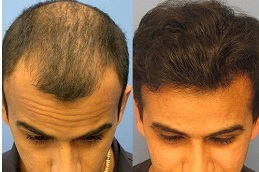 Biofibre Hair Transplant in Dubai, Abu Dhabi & Sharjah | Cost