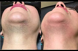 laser-hair-removal-for-womens-facial-hair in Abu Dhabi