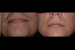  laser-hair-removal-for-womens-facial-hair-in-dubai