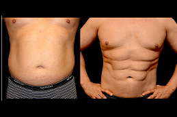 six-pack-abs-surgery-cost in Abu Dhabi