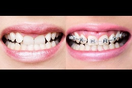 Best teeth-braces-cost Clinic in Dubai