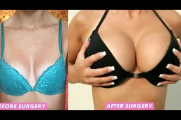 best silicone-breast-implant-cost in dubai