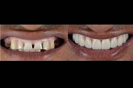 dentures-cost Clinic in Dubai