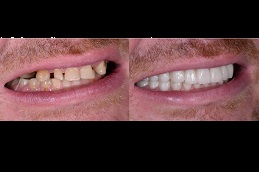 dentures-cost in dubai