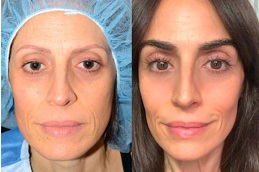 eyebrow-transplant-for-alopecia-areata Clinic in Dubai