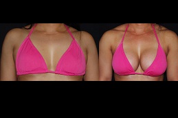 silicone-breast-implant-cost in Abu Dhabi