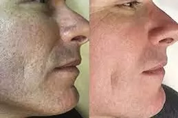 أفضل تكلفة جهاز إزالة الشعر بالليزر للرجال