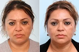 أفضل جهاز لإزالة دهون الخدود دبي