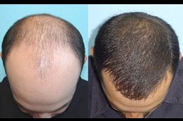 أفضل زراعة شعر بدون سكار في دبي