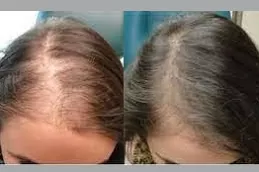 أفضل علاج PRP أرخص أبو ظبي