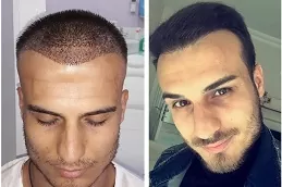 أفضل عيادة DHI لزراعة الشعر المباشر في أبوظبي