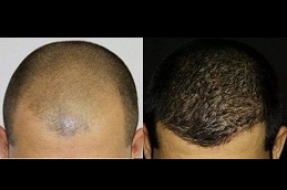 أفضل عيادة زراعة الشعر بدون سكار
