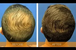 أفضل عيادة علاج PRP الأرخص