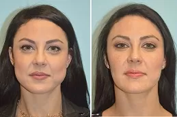 أفضل عيادة لإزالة دهون الخدود