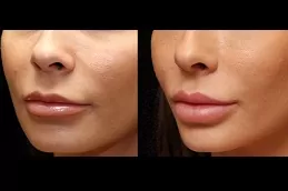 أفضل عيادة لتكبير الشفاه في دبي