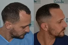 أفضل عيادة لزراعة الشعر بتقنية DHI في دبي