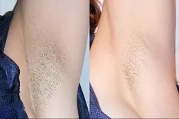 أفضل موقع برازيلي لإزالة الشعر بالليزر في أبو ظبي