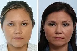 أفضل موقع لإزالة دهون الخد في أبو ظبي