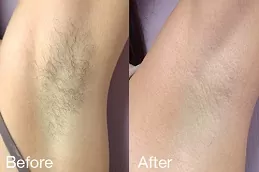 إزالة الشعر بالليزر البرازيلي دبي