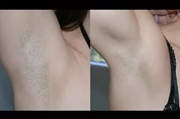 إزالة الشعر بالليزر البرازيلي في دبي وأبو ظبي