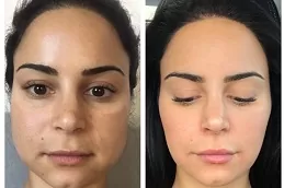 افضل عيادة علاج البوتوكس ماستر في ابوظبي