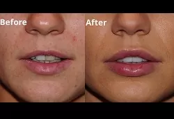 تجميل الشفة ابو ظبي