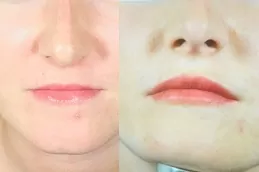 تجميل الشفة دبي