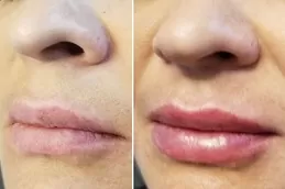 تجميل الشفة في دبي وأبو ظبي