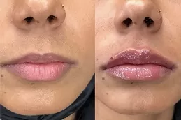 تجميل الشفة في دبي