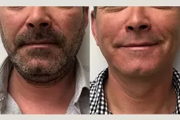 جهاز إزالة الشعر بالليزر للرجال من بيرد لاين دبي