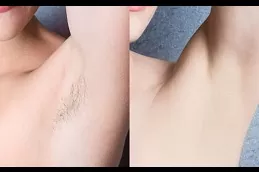 دبي أفضل عيادة برازيلية لإزالة الشعر بالليزر
