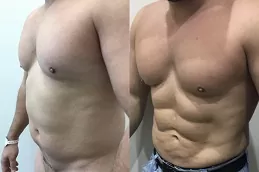 دبي أفضل عيادة شفط شفط عالية الوضوح