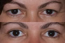 رفع العين بالبلكسر في دبي وأبو ظبي والشارقة