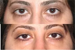 رفع العين بالبلكسر في دبي وأبو ظبي