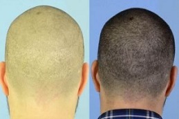 زراعة الشعر بدون سكار دبي